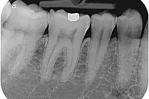 csm_Molar2_6edbf80714